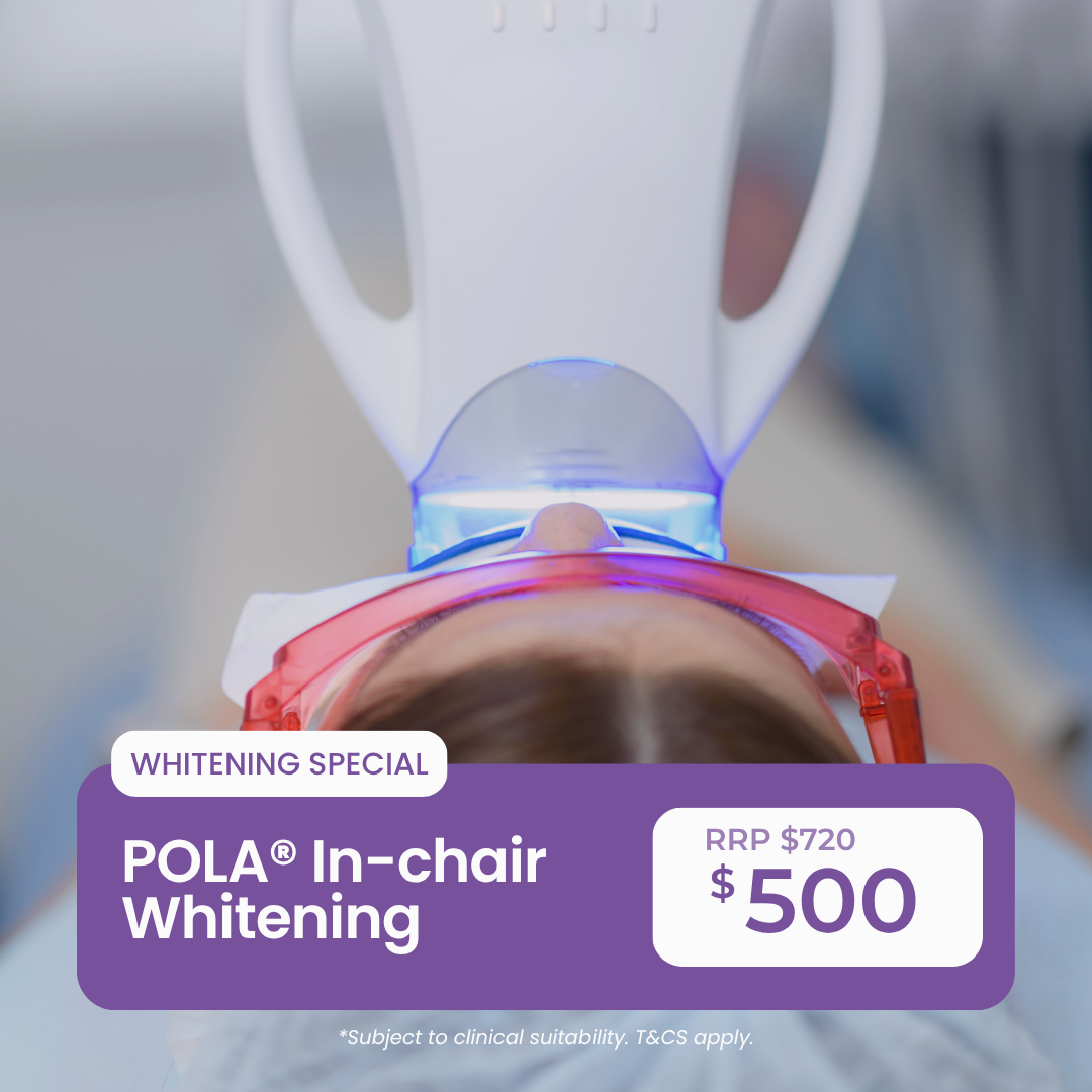 In-Chair whitening
