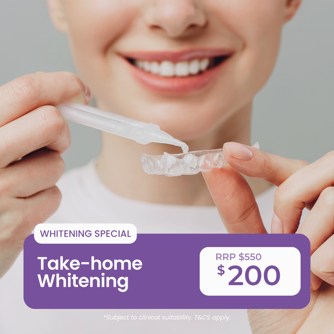Take-home Whitening